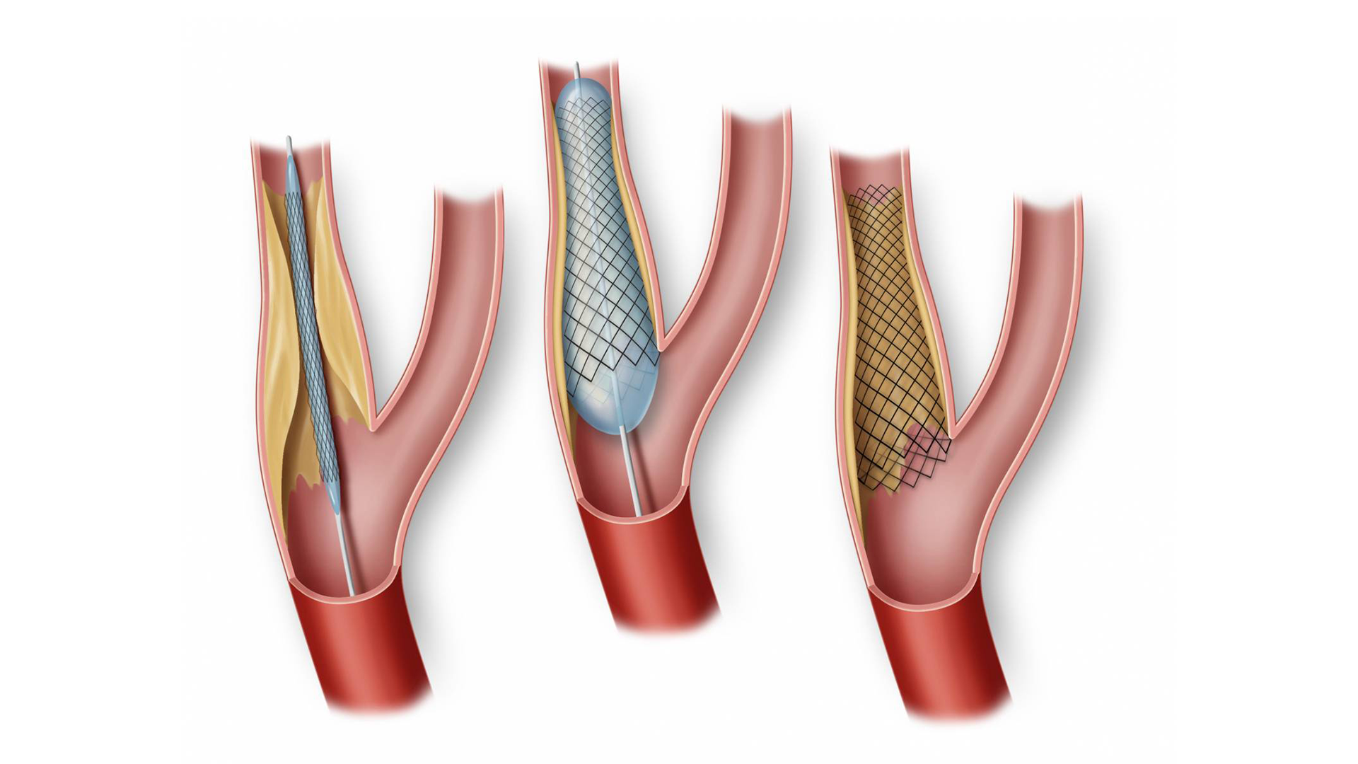 Embolizasyon