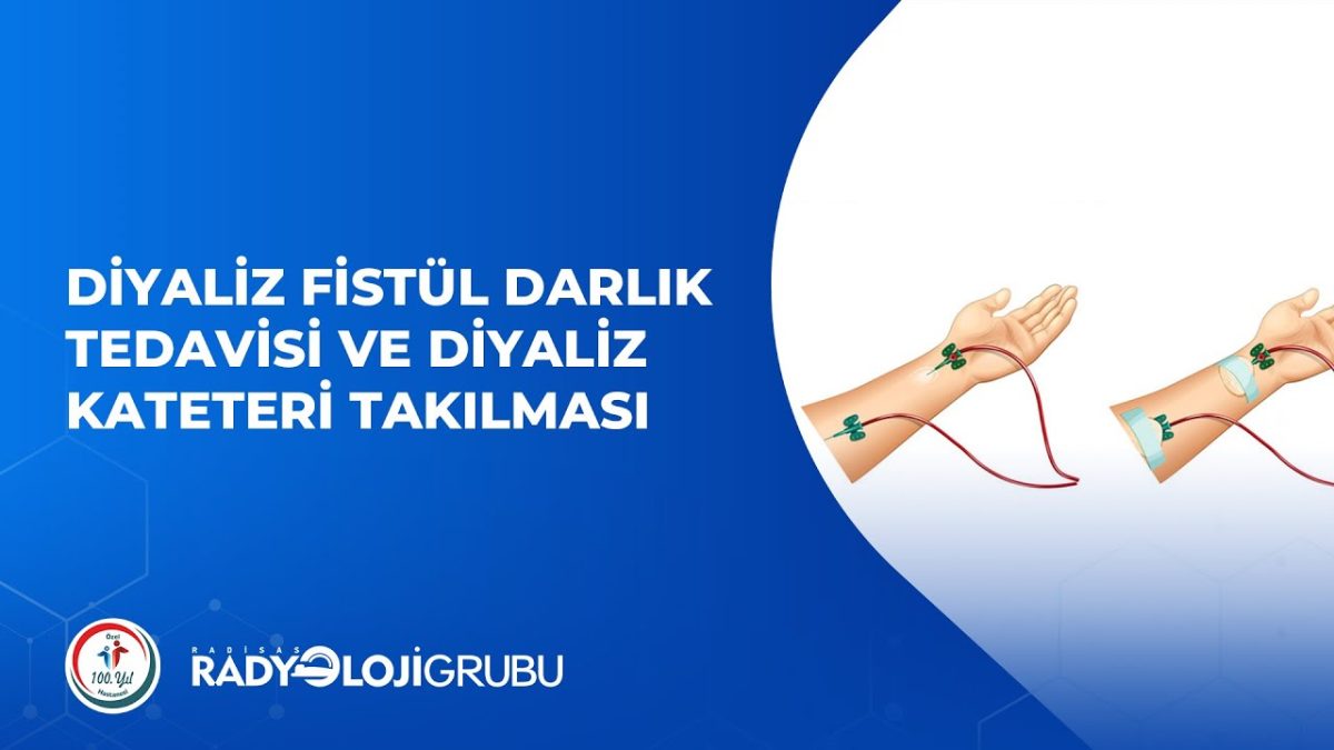 Diyaliz Fistül Darlık Tedavisi ve Diyaliz Kateteri Takılması