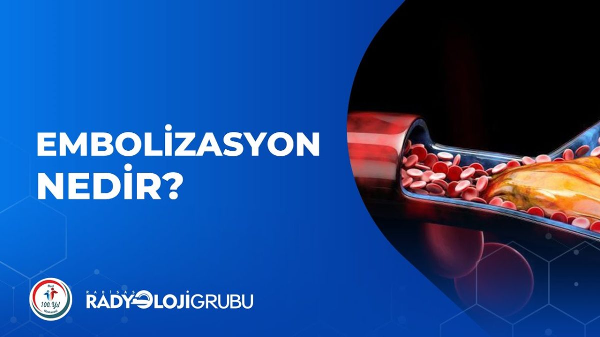 Embolizasyon