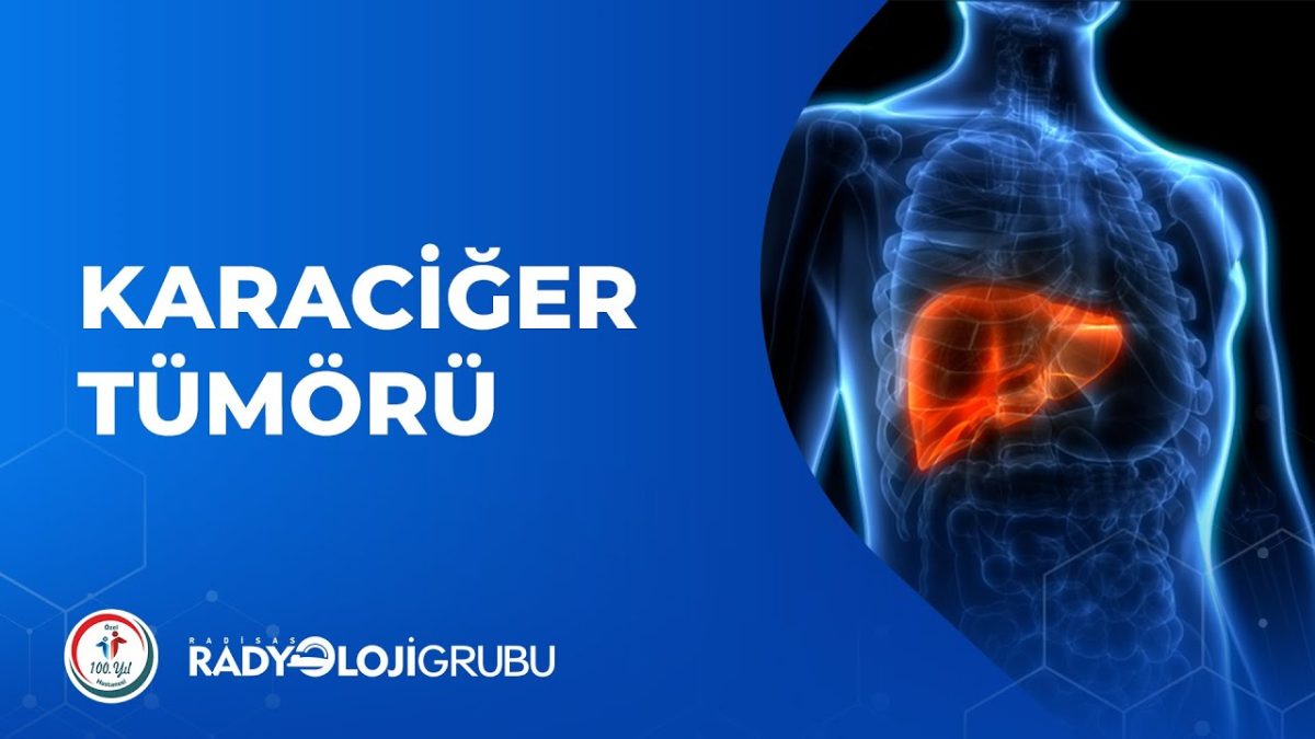 Karaciğer Tümörü Tedavisi 